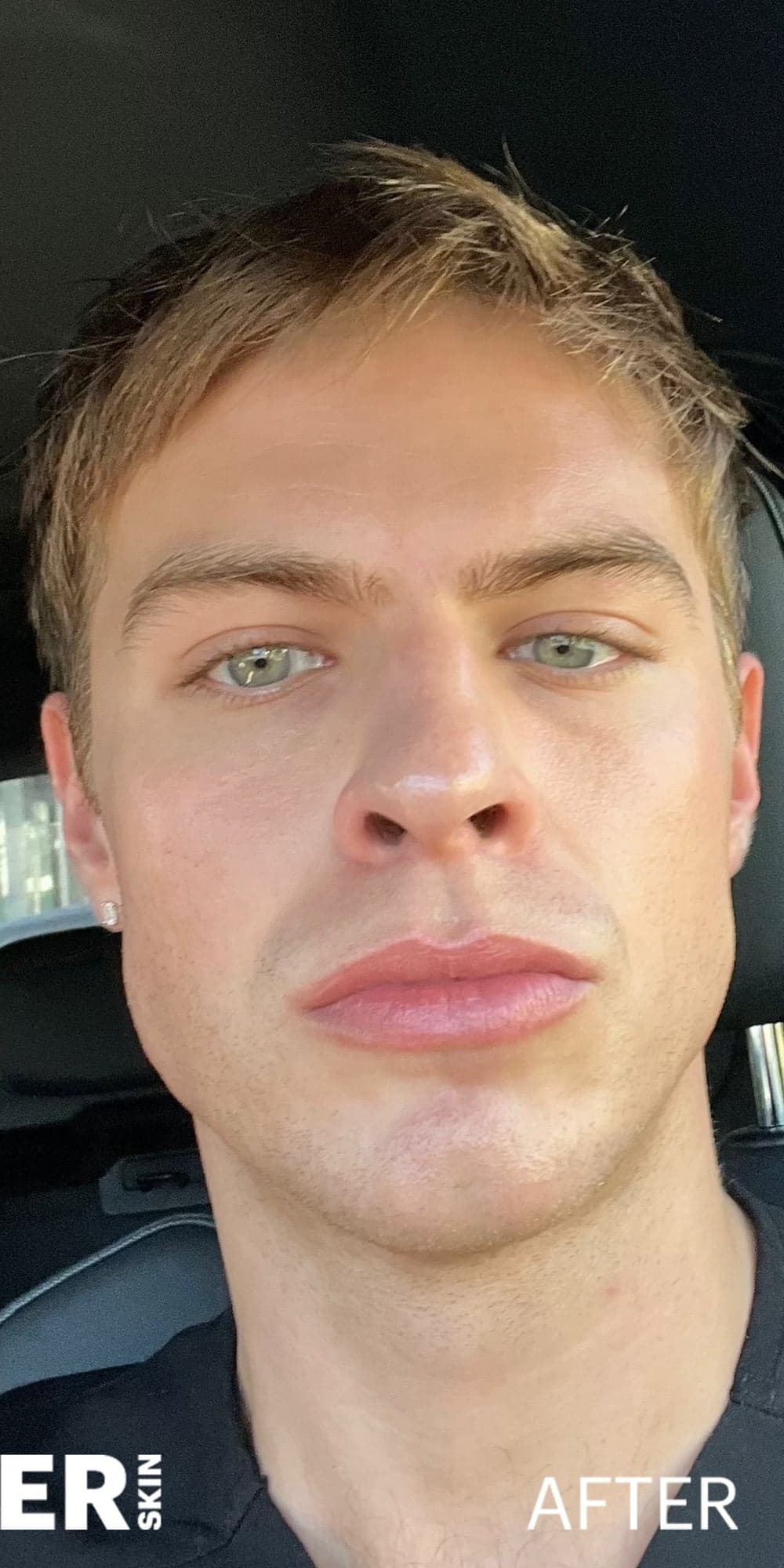 MAXORIS Facial Sculpting — After