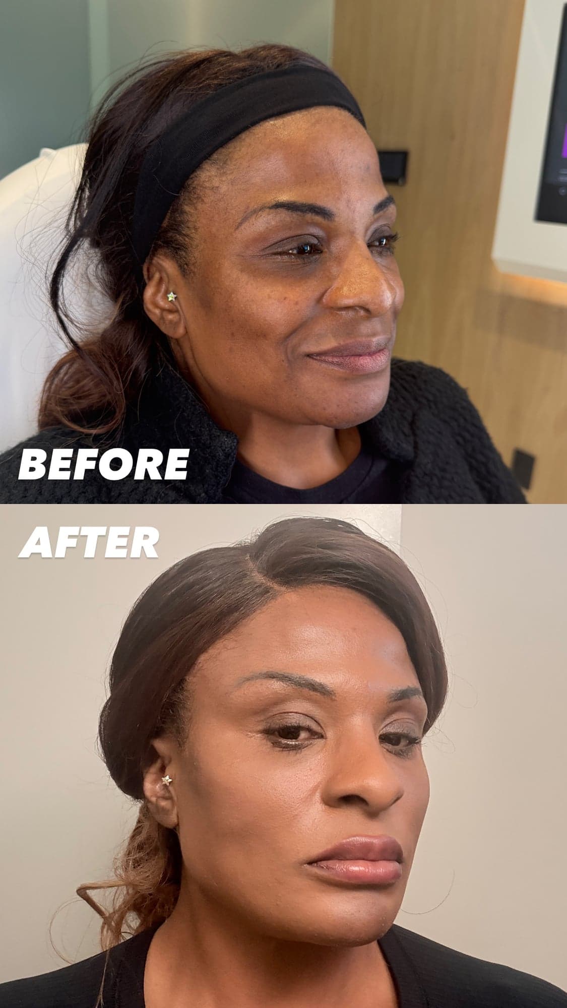 Female Facial Sculpting — before and after