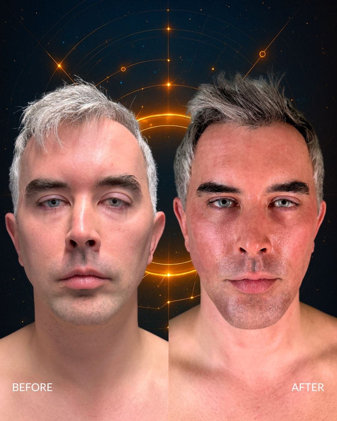 Male Facial Sculpting — before and after