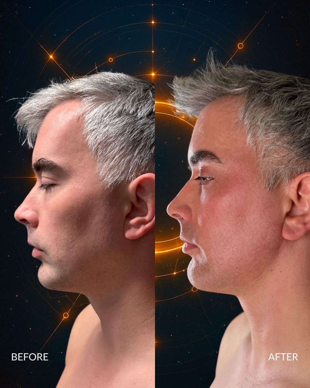 Male Facial Sculpting — before and after