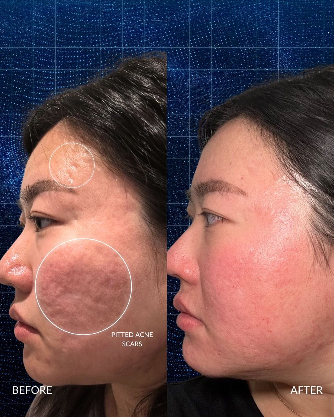 Acne Scar Reconstruction Before and After