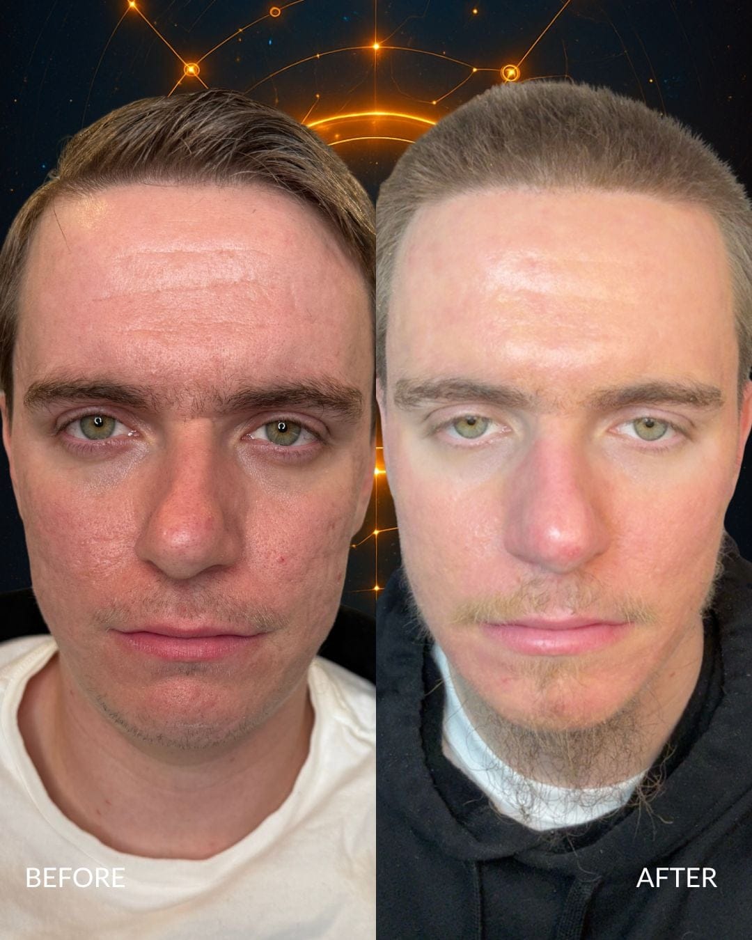 Acne Scar Treatment Before and After