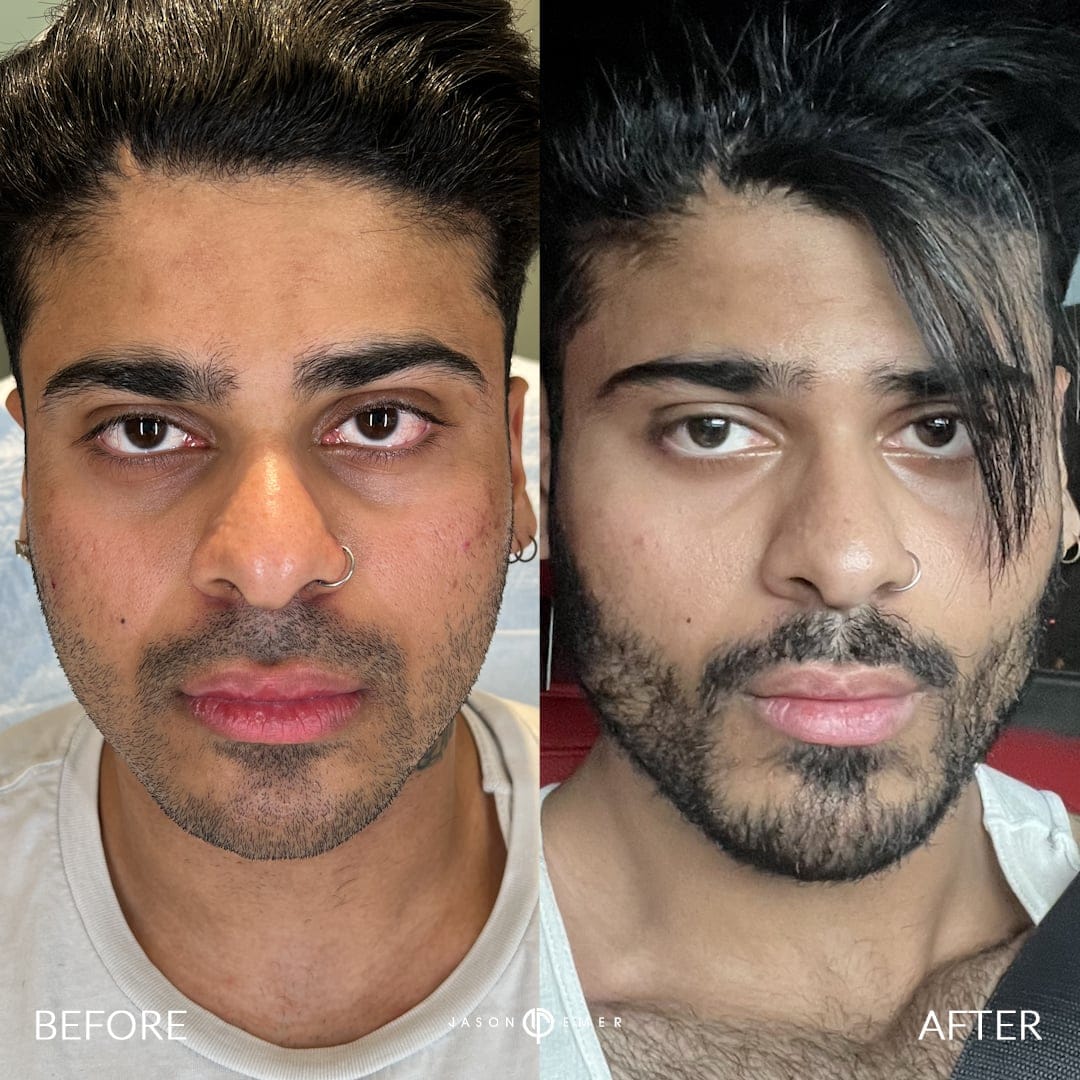 Male Facial Sculpting Before and After