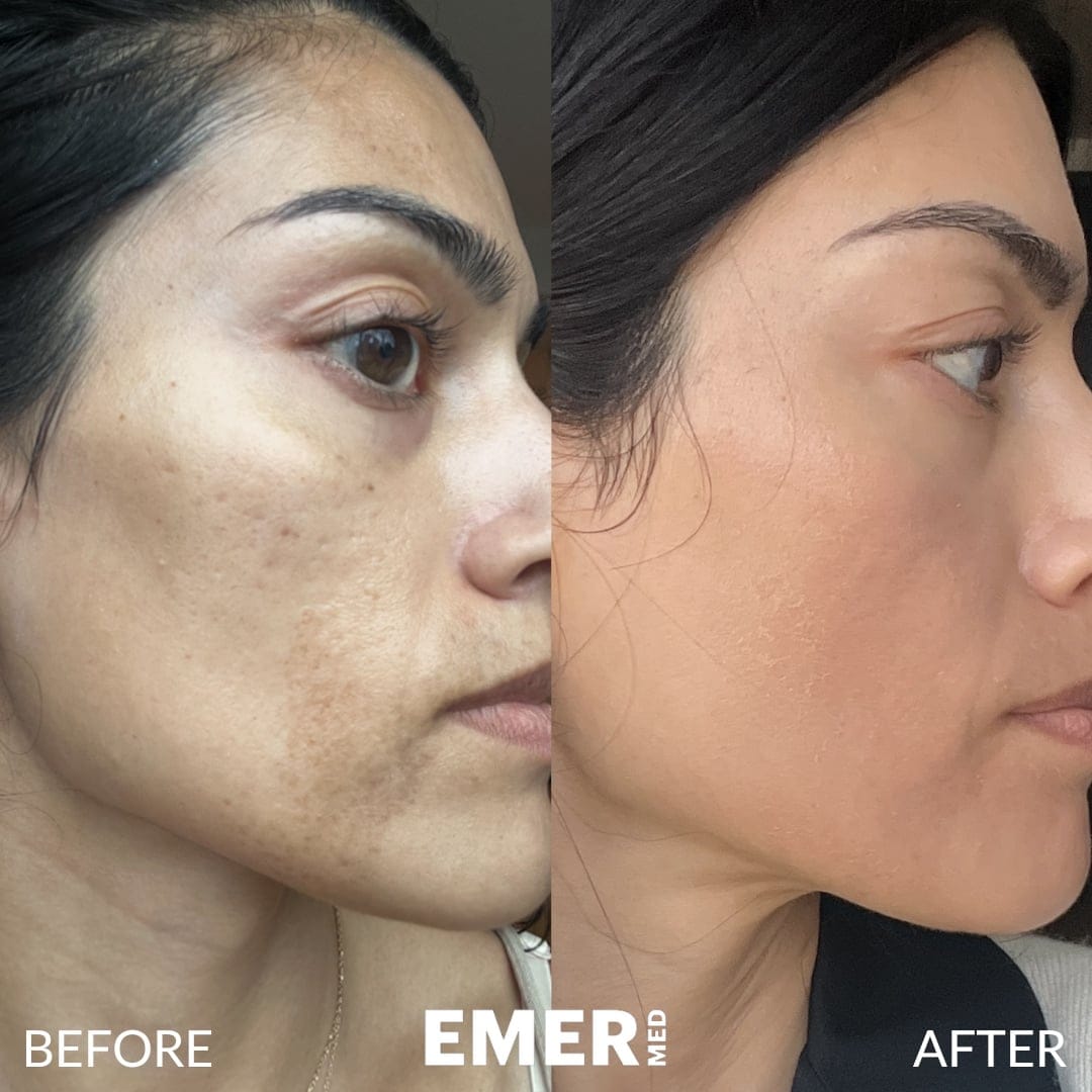 Acne Scar Treatment Before and After