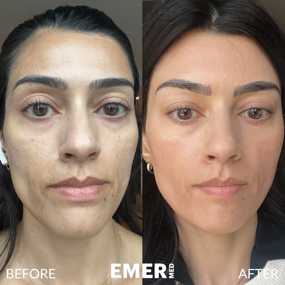 Acne Scar Treatment Before and After